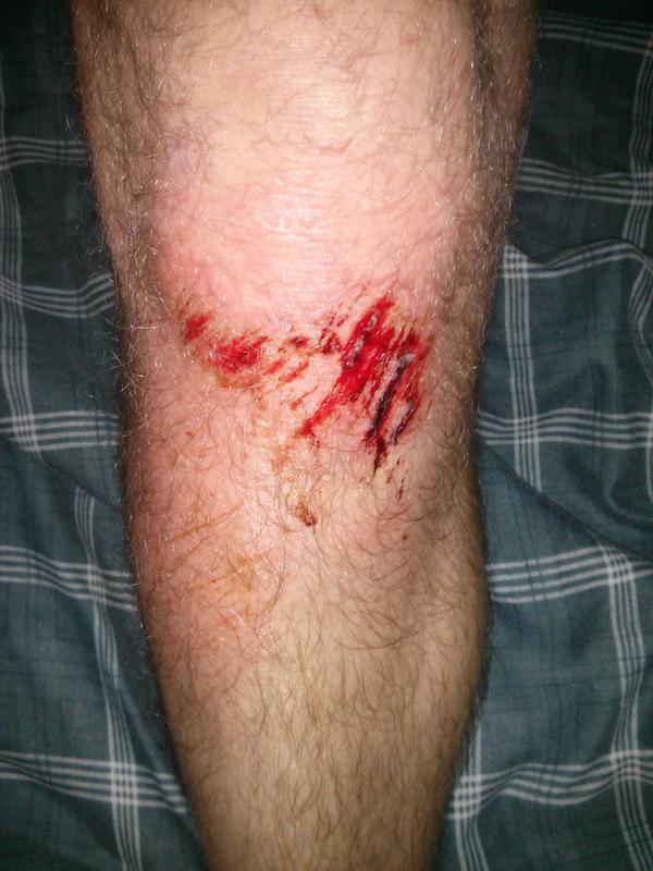 The road bit me earlier (running, mud+corner). Thankfully not @ZombiesRunGame zombies.
To do: visit @moreteadoctor :)  - embedded image 