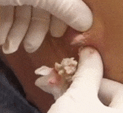 RT Are you a secret fan of #popping? @ladyhaja explains cyst explosions & blackhead pops online. http://t.co/o5j4TbjS9w  - embedded image 